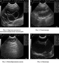 Узи картина плодного яйца. Жидкость в матке операция. Жидкость в малом тазу заключение узи. Перфорация матки презентация. Фото миомы матки на узи при беременности.